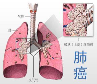如何了解肺癌并对其进行治疗?