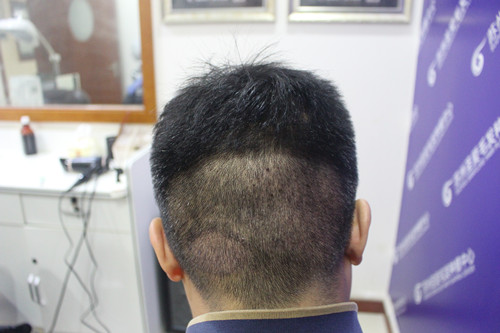 疤痕性脱发能长出来吗?案例对比图