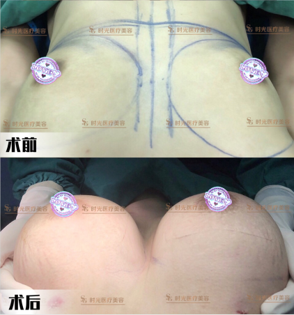 假体隆胸是什么原理？惠州时光医院隆胸技术怎么样？