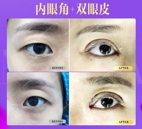 上海诺诗雅做眼部综合技术怎么样？眼部综合有哪些手术？