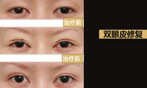 关于割双眼皮有哪几种方式？广州美恩医学美容医院做眼部整形怎么样？
