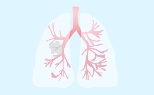 用射波刀治疗肺癌效果如何？