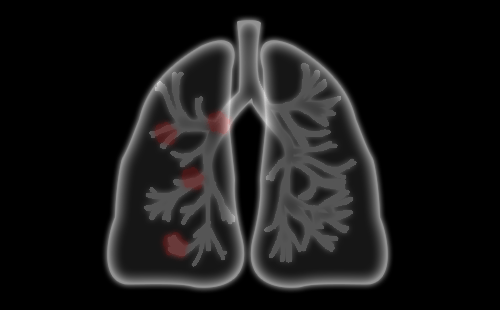 肺癌早期症状不明显吗？接触这些高风险因素的人要注意肺癌