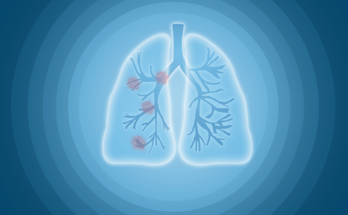 早期肺癌的高危信号，注意到了么？