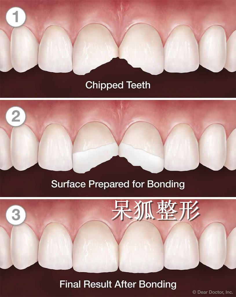 门牙断了一半修复图对比 上海哪家口腔医院可以修复门牙？