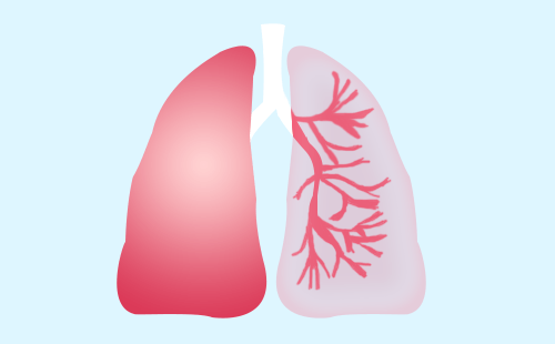 肺癌易与哪些疾病混淆？诊断为肺癌还可以活多久？