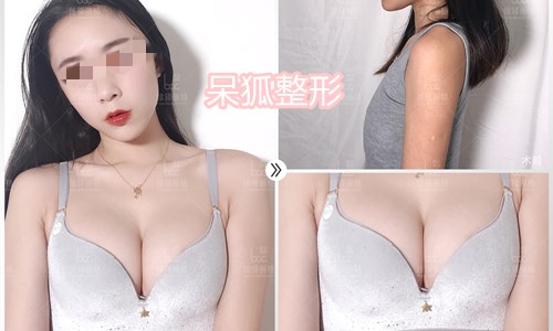 自体脂肪丰胸