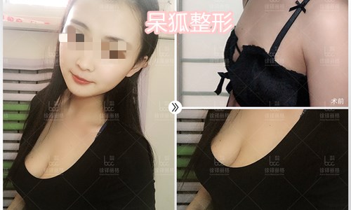 自体脂肪丰胸