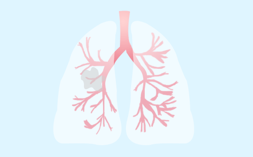 射 波 刀 治 疗 肺 癌