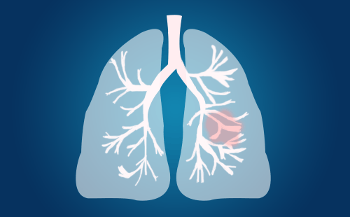 肺部结节影是什么意思啊？
