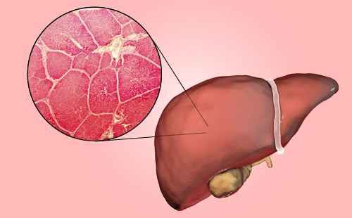 胰腺癌肝脏转移如何治疗？