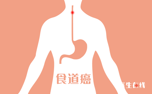 食管癌的症状表现有哪些?吞咽异常是食管癌吗？