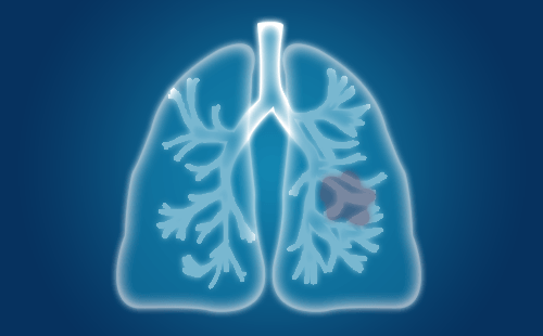 如何根据肺癌的严重程度来判断肺癌的早中晚期？为什么？