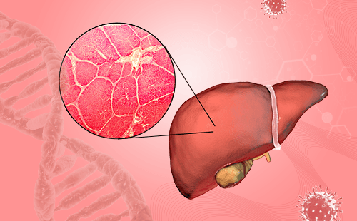 胰腺癌复发是什么原因？和生气有关吗？