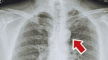 胸片"纽扣"阴影为何误诊肺癌