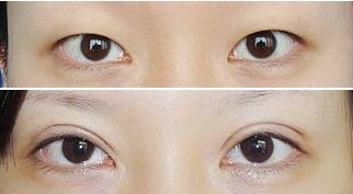 割双眼皮前后对比效果明显吗?