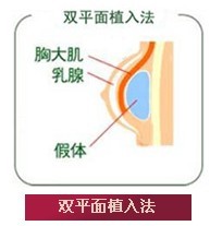 假体隆胸哪种植入位置适合您