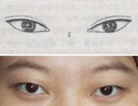 哪些眼型适合做韩式双眼皮?