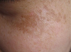 色斑属于色素障碍性皮肤病,常见的色斑包括雀斑,黄褐斑,老年斑,咖啡斑