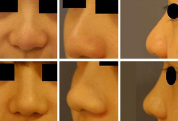 什么是蒜头鼻?蒜头鼻图片