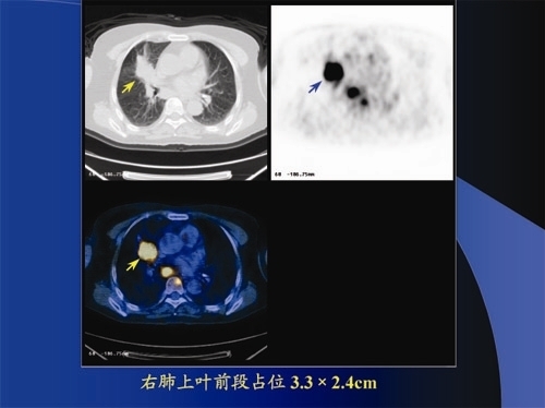 pet/ct检查:肺癌的分期ii