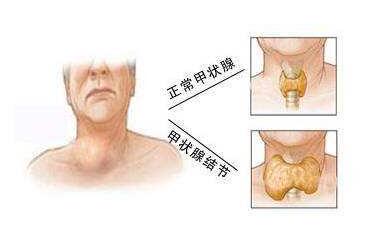 甲状腺结节图片位置图片