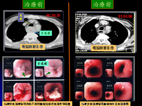 食道癌放疗图片