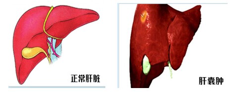 原發性肝癌症狀|肝囊腫會變成肝癌嗎?