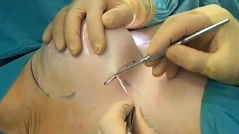 乳房切除恢复图片