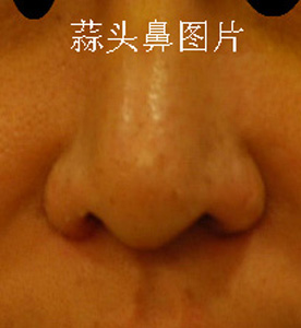 什么是蒜头鼻?蒜头鼻图片