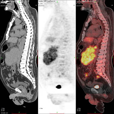 pet-ct检查发现腹部淋巴瘤